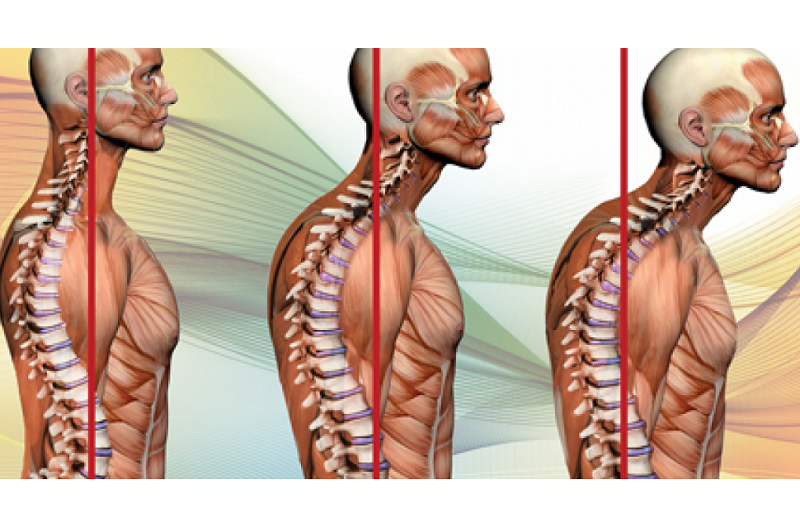 What is the Hump at the Back of Your Neck? - PhysioCore Therapy